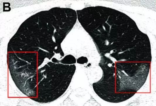 O terapie inovatoare, folosită în cazul pacienților care au plămânii afectați de infecția cu COVID-19  de la Spitalul din Timişoara