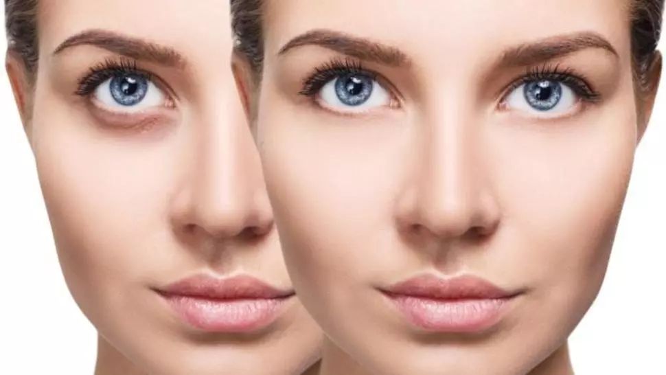 Trucuri simple pentru a reduce cearcănele și pungile de sub ochi