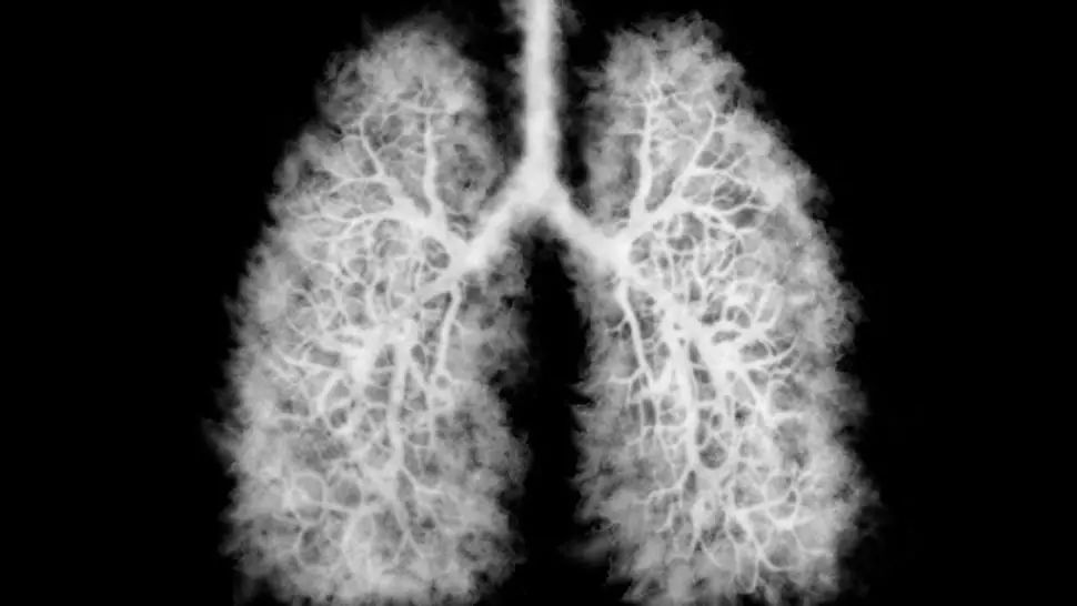 Testul de screening pentru cancerul pulmonar