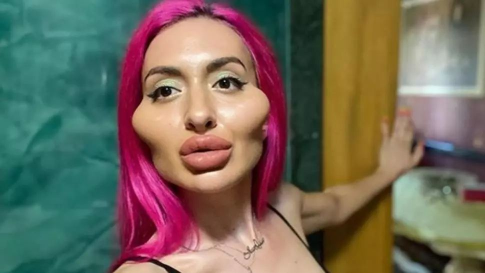 Povestea tulburătoare a tinerei care își injectează singură pomeții. Cazul care a șocat lumea medicală 