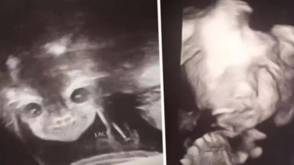 După ecografie, a împietrit: "E copilul diavolului! Mi se uită direct în suflet!" Ce purta în pântec