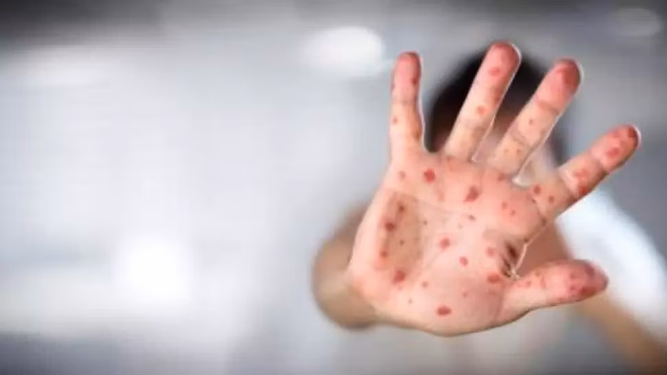 Primul deces de rujeolă din acest sezon. Victima, un bebeluș de 7 luni al cărui frate de 3 ani nu era vaccinat ROR