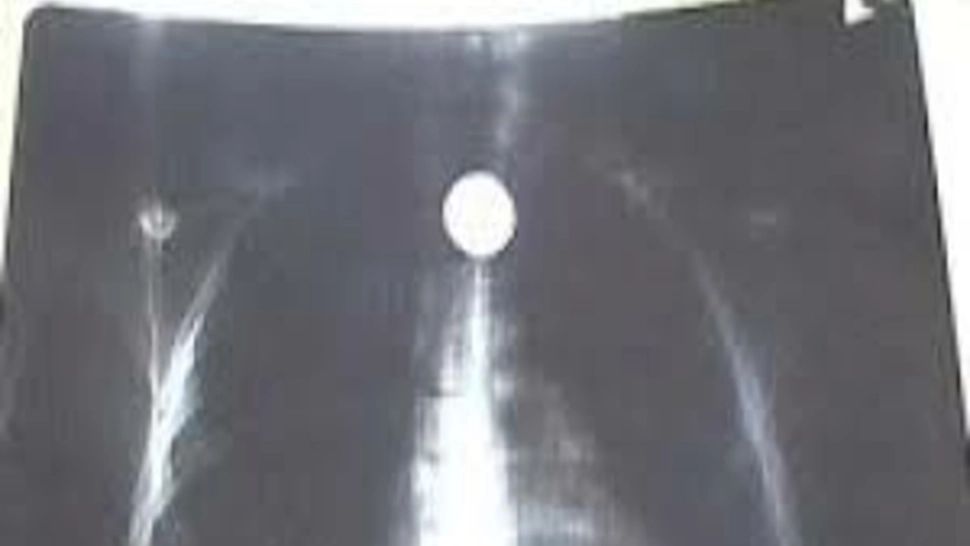 Un copil în vârstă de 3 ani, din Botoșani, a ajuns la spital după ce înghițit o monedă de 50 bani