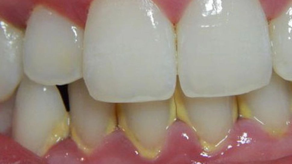 Cum scapi RAPID de tartrul de pe dinți fără să mergi la dentist