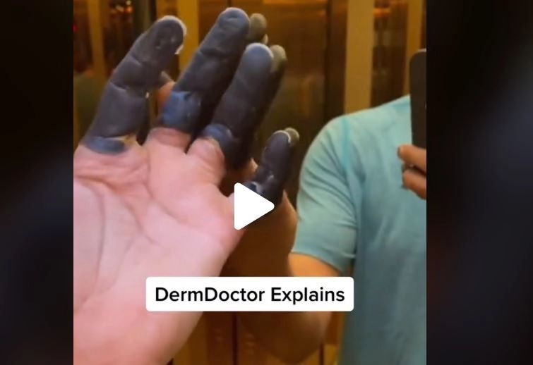  VIDEO – I s-au înnegrit degetele brusc – A mers de urgență la spital și medicii i-au dat verdictul crunt: amputate pe loc