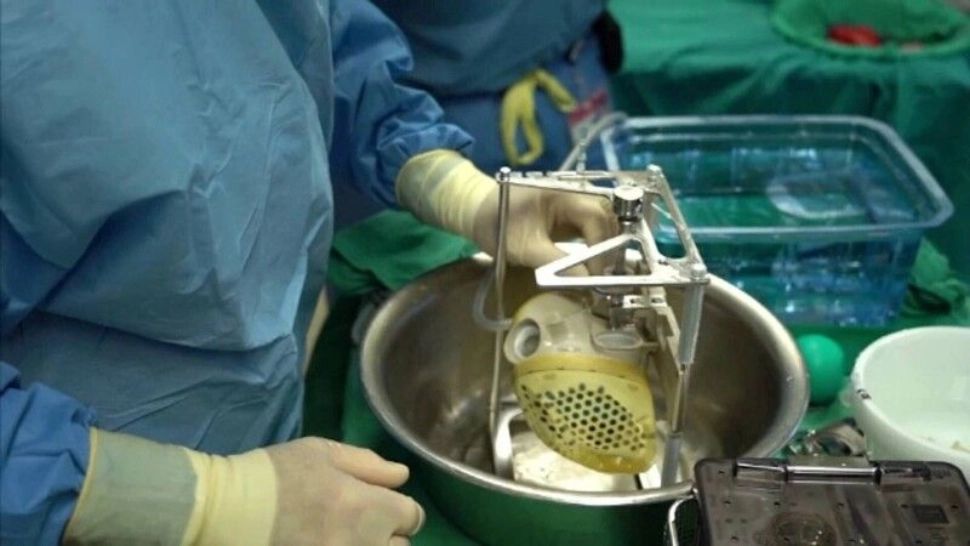 Prima femeie din SUA care primeşte o inimă artificială