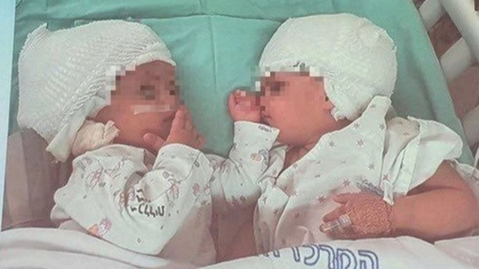 FOTO | Siameze unite în dreptul cefei, separate după o intervenţie chirurgicală extrem de rară, în Israel