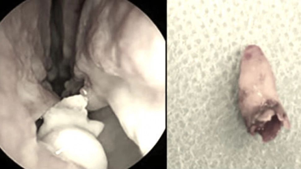 Credea că are nasul înfundat. La operație, s-a dezlănțuit coșmarul! Ce era, de fapt, acolo