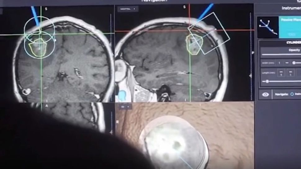 VIDEO | Femeie cu tumoră cerebrală de 5 centimetri, operată cu succes în Iași. Declarațiile emoționante ale pacientei