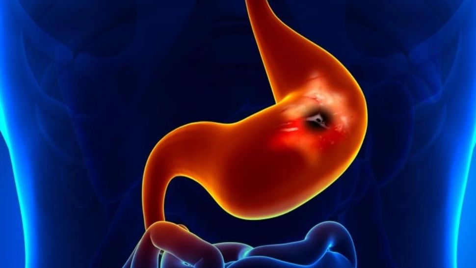 Leguma care vindecă rapid ulcerul. În plus, te ajută să slăbești și îți întărește imunitatea