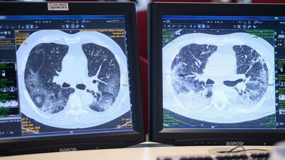 Cum afectează Covid-19 inima bolnavilor chiar și după ce aceștia au trecut prin boală. De ce persistă  simptomele luni de zile de la vindecare