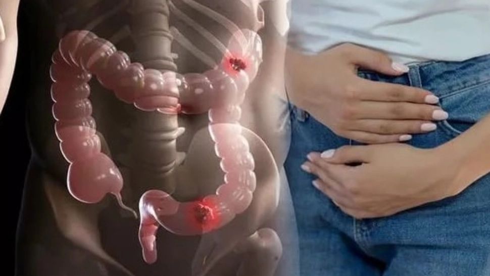 Cel mai periculos obicei alimentar care crește riscul de cancer la colon