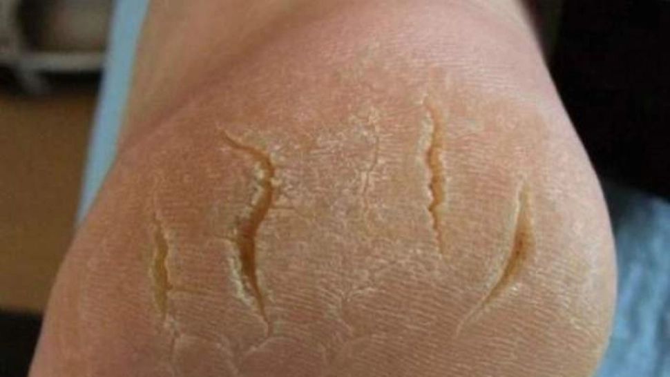 Cum să scapi definitiv de călcâiele crăpate. Medicii avertizează: ascund BOLI GRAVE 