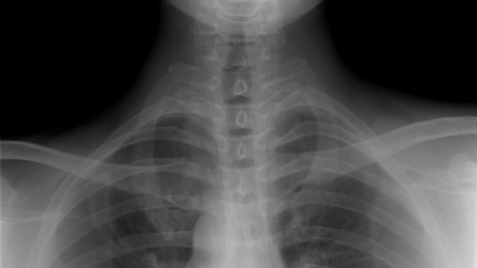 S-a dus la doctor, crezând că are tuberculoză. La analize, medicii au rămas muți! Ce pățise, de fapt, femeia - caz medical UNIC