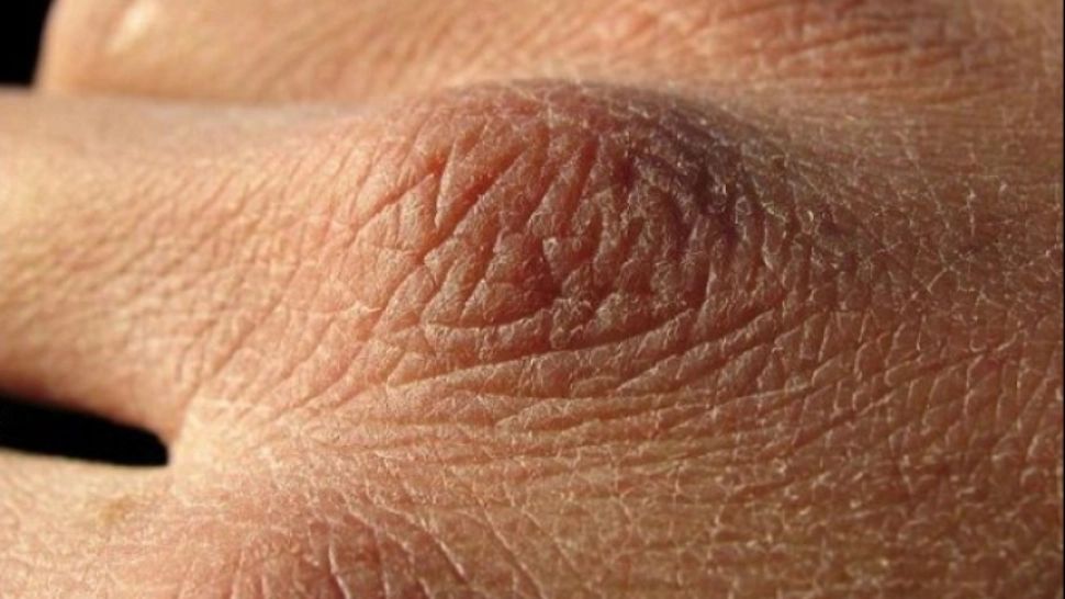 Ce înseamnă dacă pielea de pe mâini arată așa? E un simptom care îți pune în pericol sănătatea