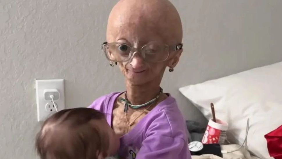 Adalia Rose Williams, "fetița bătrână", a murit la vârsta de 15 ani