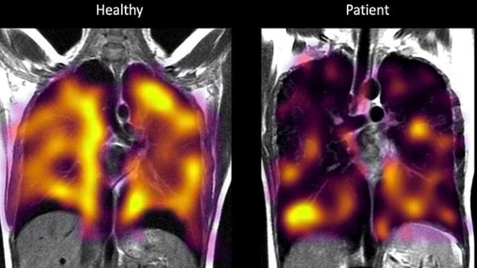 Un studiu controversat sugerează o posibilă legătură între vaccinurile COVID și riscul crescut de cancer. Cum a reacționat comunitatea științifică?