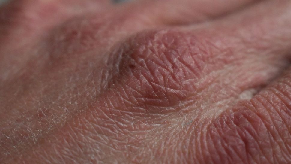 Ai acest semn pe piele? Ia măsuri! Riști să ai probleme cu colesterolul