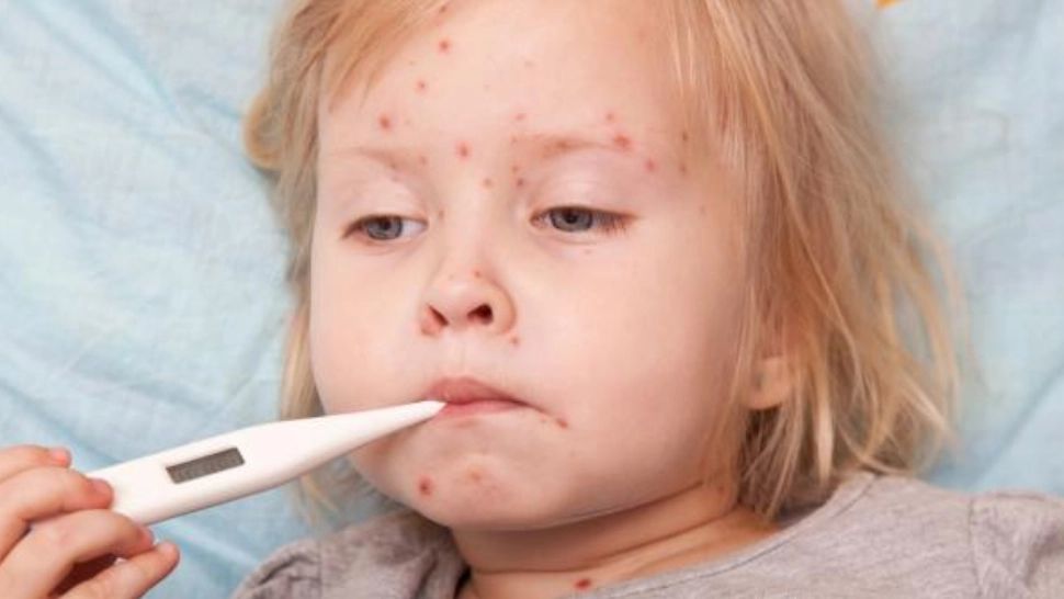 Mai multe focare de VARICELĂ, active la unele scoli şi grădinițe din Constanța! Reacția DSP: Deocamdată NU este vorba de epidemie