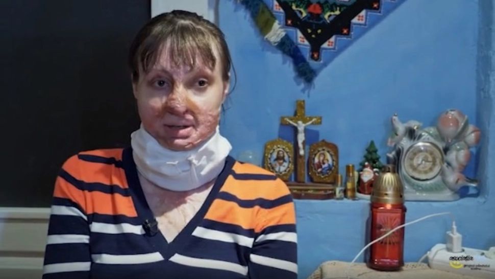 Drama fetei care a ars în casă. Are nevoie de 5.000 de euro pentru operații