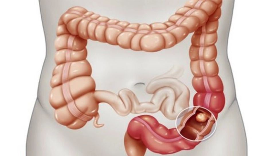 Alimentele care cresc riscul de cancer la colon - scoate-le acum din alimentație!