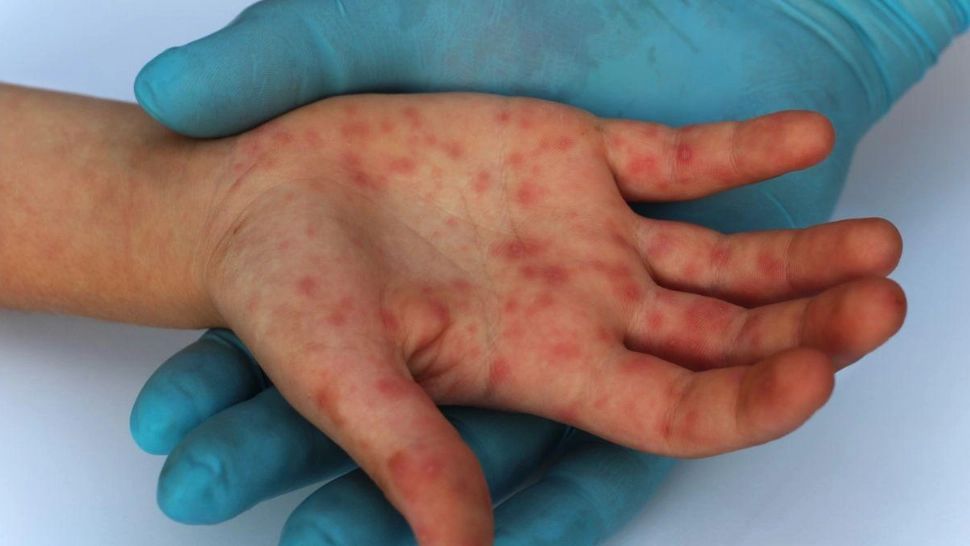 Un nou caz de variola maimuței a fost diagnosticat în România 