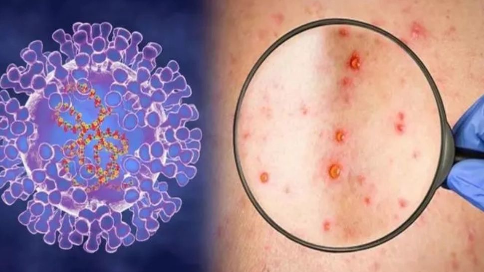 Variola maimuței. Peste 5.000 de cazuri confirmate. Creștere cu 50% a infectărilor în doar 2 săptămâni