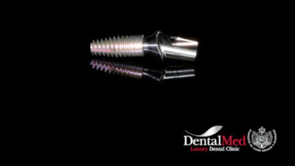 Implantul dentar doare? Cât durează recuperarea post-operatorie? (P)