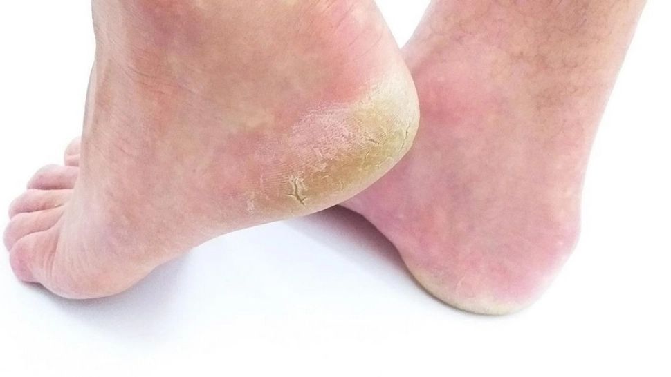 Remedii făcute în casă pentru călcâiele uscate și crăpate. Vei scăpa imediat de această problemă inestetică