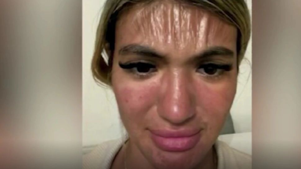 Ce a pățit o turistă după ce a adormit pe o plajă din Bulgaria: chipul său, de nerecunoscut