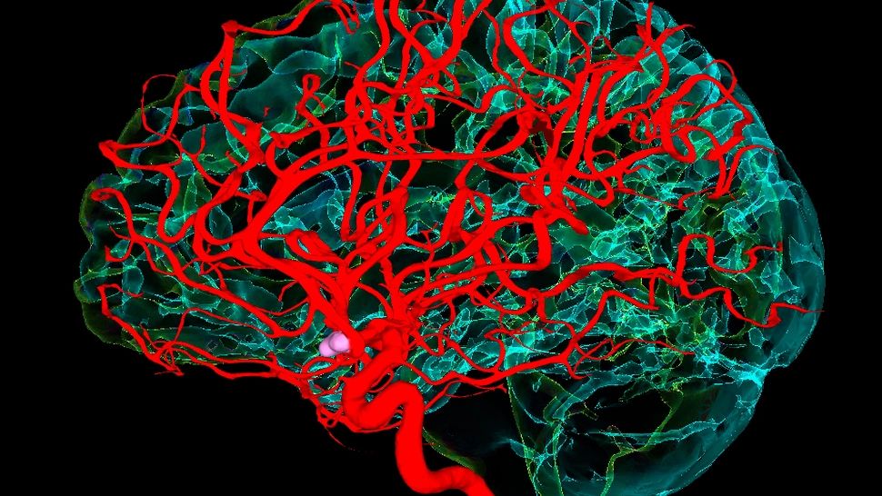 Accident Vascular Cerebral. Cum te recuperezi după un AVC. Ce simptome post-AVC poți avea