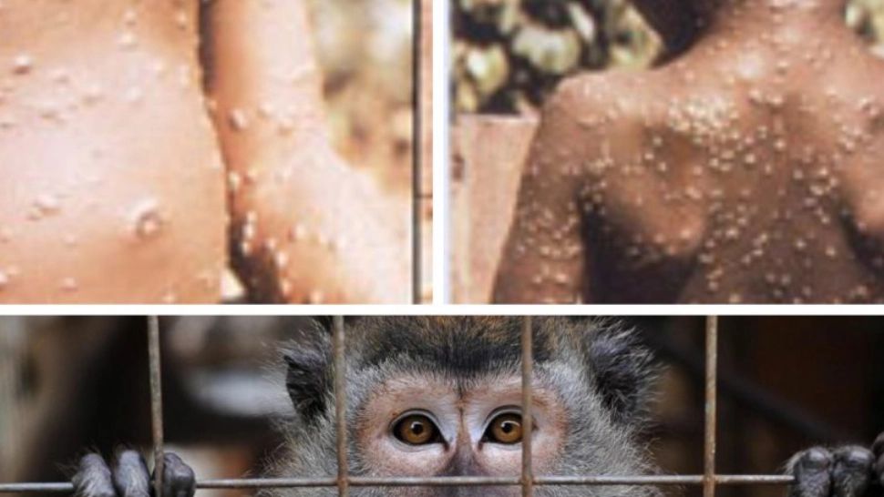 Un nou caz de variola maimuţei, confirmat în România. Numărul total al celor infectați a ajuns la 37 de persoane