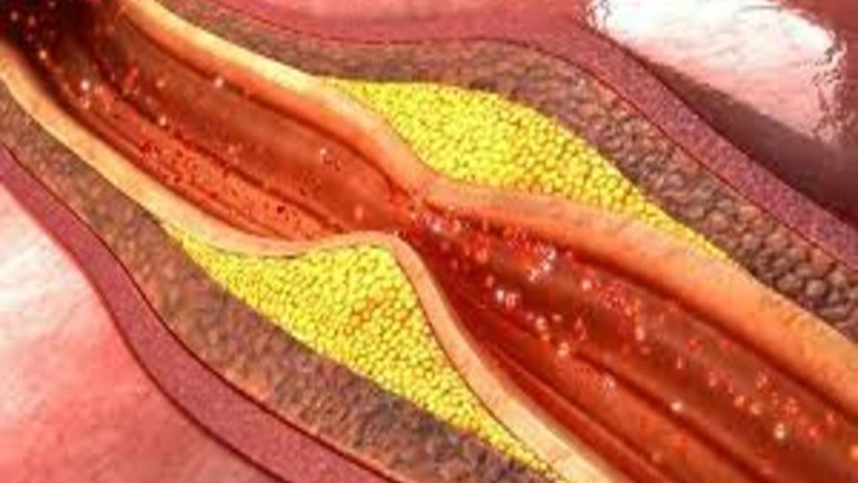 Ateroscleroza: cauze, simptome, măsuri de prevenție