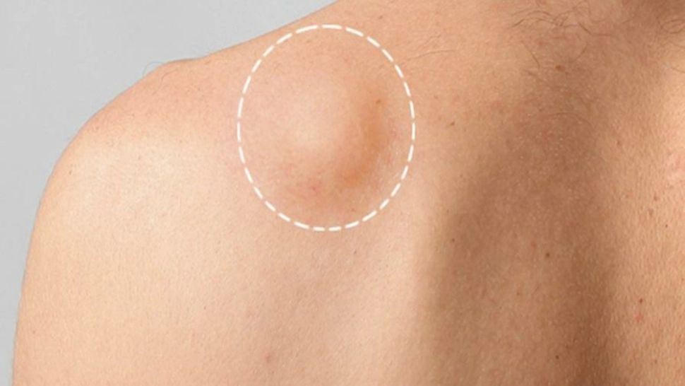 Dacă ai acest SEMN pe piele, mergi de urgență la medic. Cât de periculoase sunt lipoamele pentru sănătate