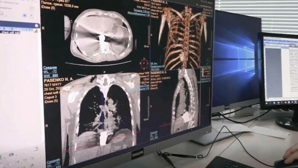 Bombă ucraineană neexplodată scoasă din pieptul unui soldat rus. Intervenție chirurgicală extrem de riscantă la Moscova