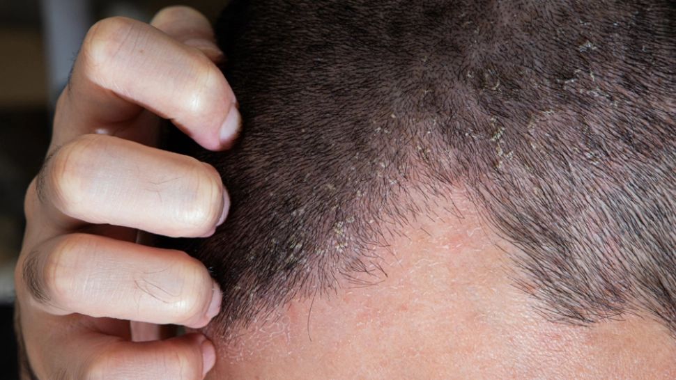 Dermatita seboreică: care sunt simptomele și când trebuie să mergi la doctor
