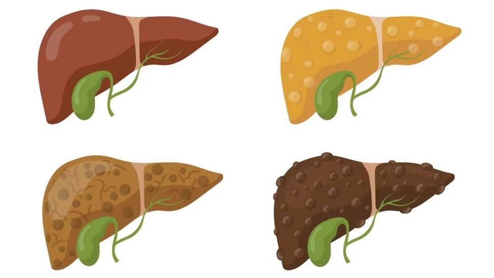 Boala ficatului gras: simptomele care se văd pe față