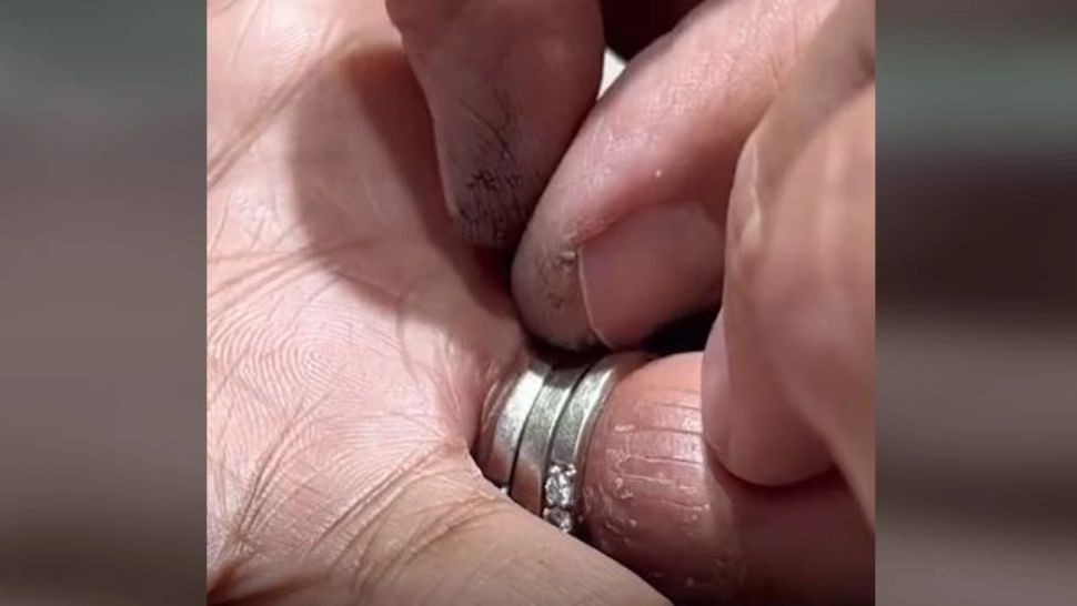 VIDEO – A stat 15 ani cu trei inele blocate pe deget – Cum au fost scoase până la urmă