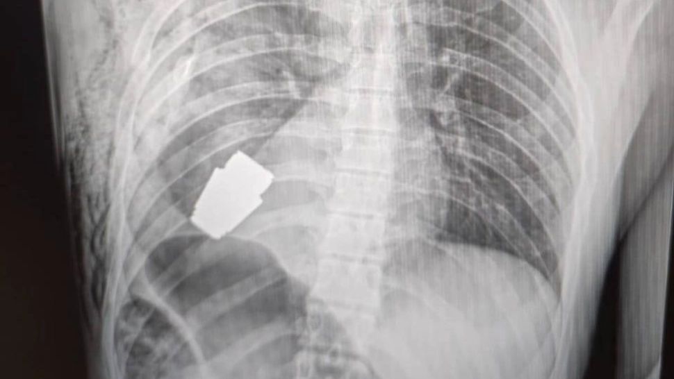 Medicii militari din Ucraina au scos o grenadă neexplodată din corpul unui soldat