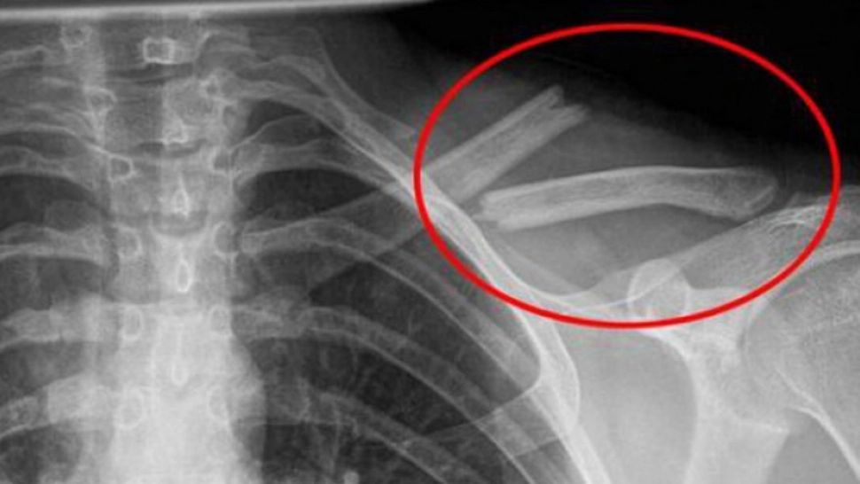 Otrava asta îţi distruge oasele! O bei în fiecare zi fără să știi cât de toxică este pentru organism