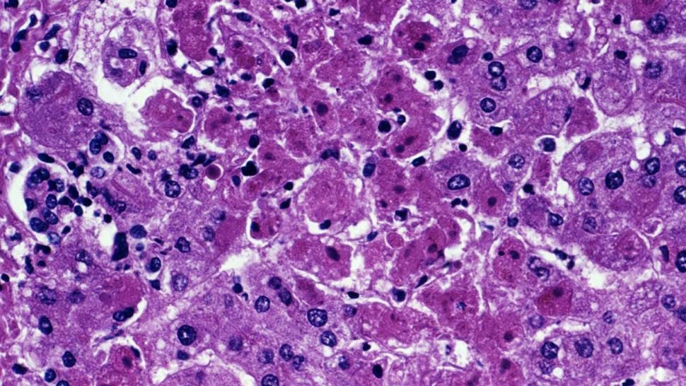 Alertă în Europa: Febra hemoragică Marburg, MORTALĂ, depistată la o persoană care a fost în focarul african - Nu există tratament