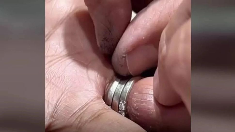 VIDEO – A stat 15 ani cu trei inele blocate pe deget – Cum au fost scoase până la urmă