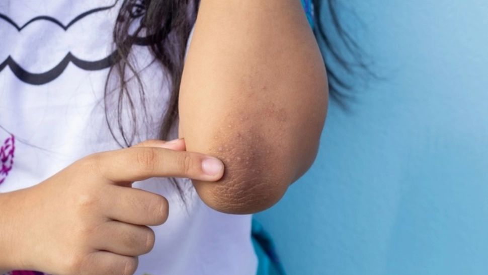 Ai observat că ai astfel de pete pe piele? Iată de ce boală ai putea suferi
