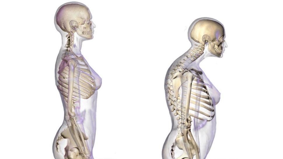 Studiu alarmant: poluarea aerului ar putea provoca OSTEOPOROZĂ