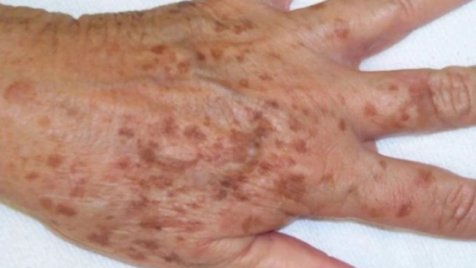 Ai acest tip de pete pe piele? Poți suferi de o boală gravă: avertismentul medicilor 