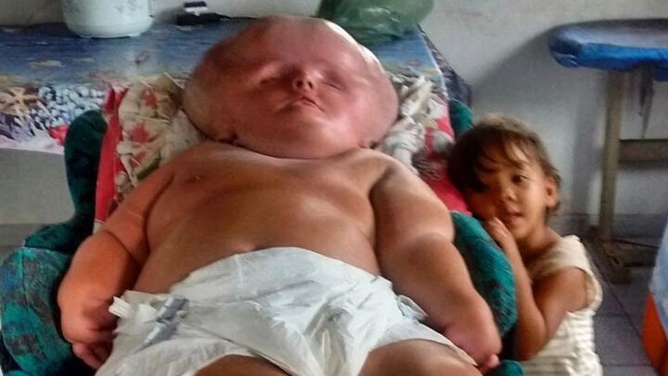 Caz medical șocant. Femeia cu cel mai mare CAP din lume. "Crește într-una, nu se oprește" - FOTO GALERIE