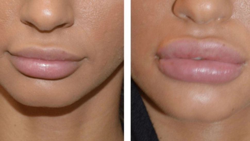 O influenceriță a murit după ce și-a injectat acid hialuronic - Trupul tinerei a fost găsit aruncat într-un râu