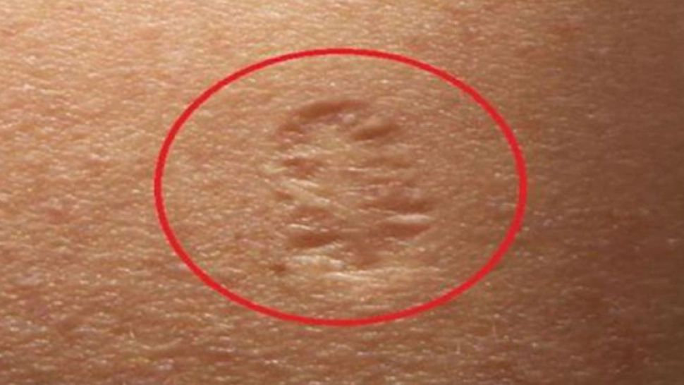 Și tu ai acest semn pe braț? Care este adevărata lui semnificație: ni s-a spus că e de la vaccin, dar...