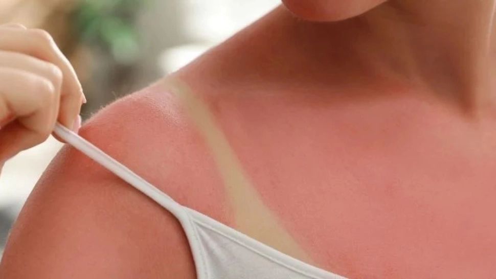 În cât timp trec arsurile solare? Cele mai eficiente remedii - Când e cazul să mergem la medic