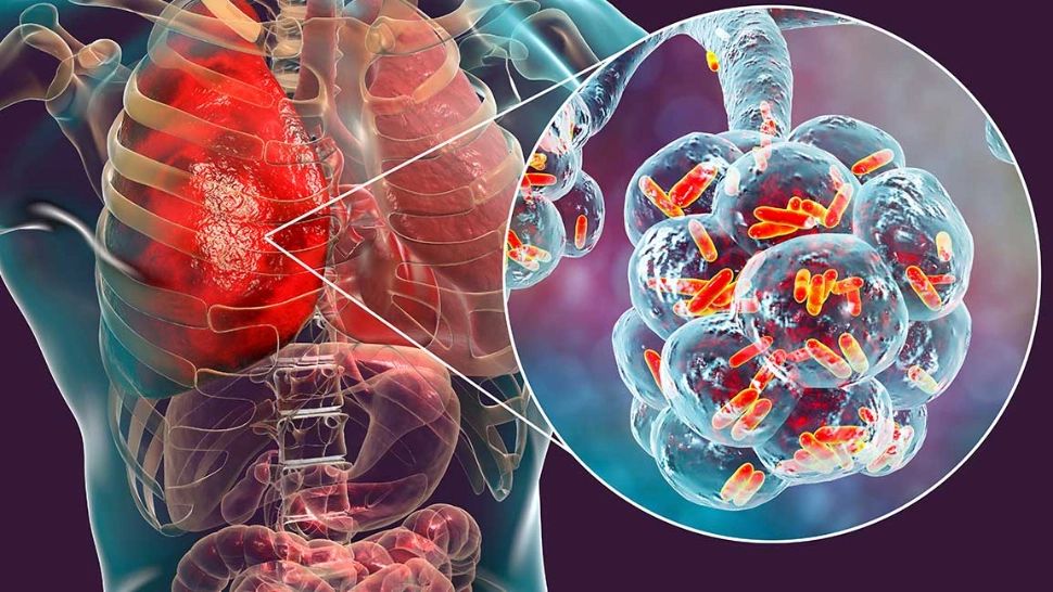 Bilanț sumbru aproape de România: 11 morți și 144 persoane infectate cu legioneloză în Polonia